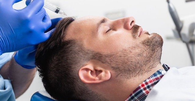 Hair Restoration with PRP Microneedling