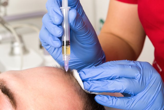 Hair Restoration with PRP Microneedling